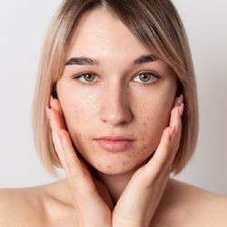 Není akné jako akné. Jaké formy existují?